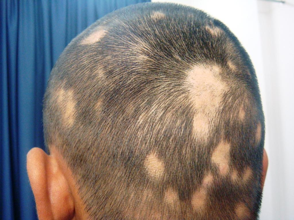 alopecia